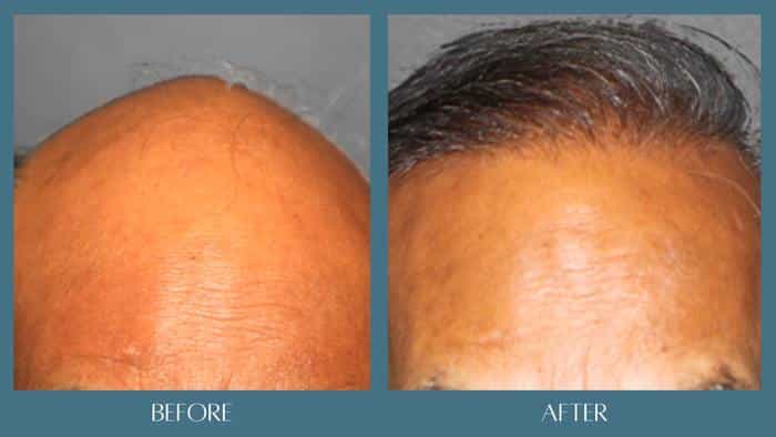 before after hair restoration treatment 2