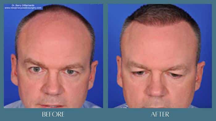 before after hair restoration treatment 3
