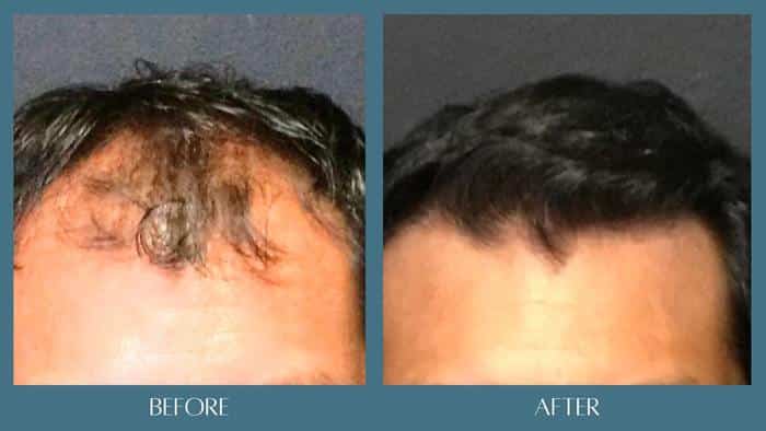 before after hair restoration treatment 4
