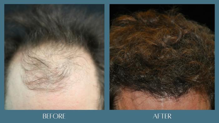 before after hair restoration treatment